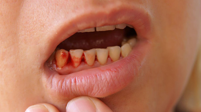 Gum Disease & Treatment
