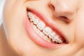 Harga Braces Malaysia: Antara Kerajaan dan Swasta (2025)