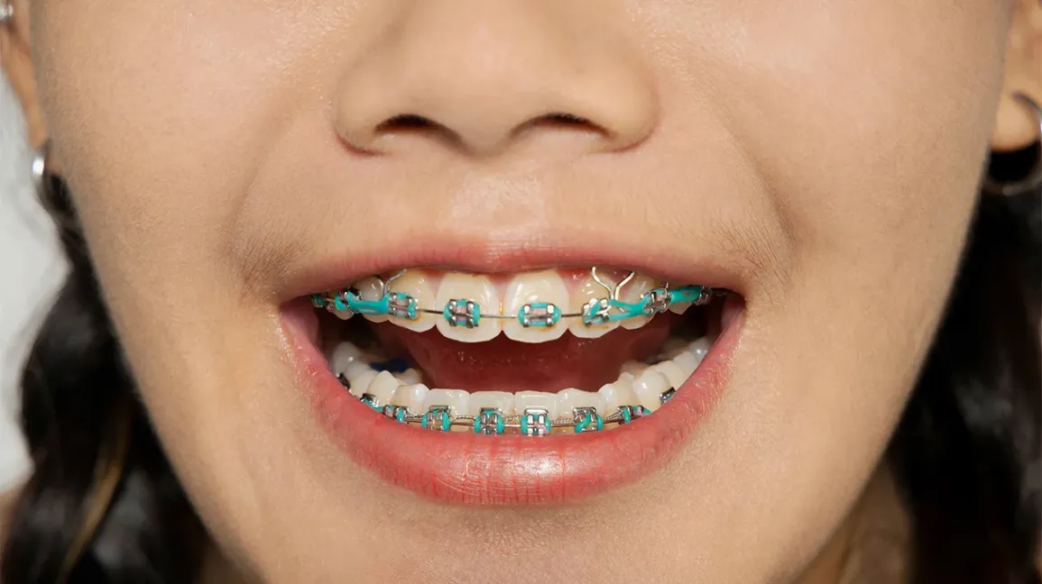 Braces Gigi: Panduan Lengkap dari Orthodontis (Doctor Gigi)