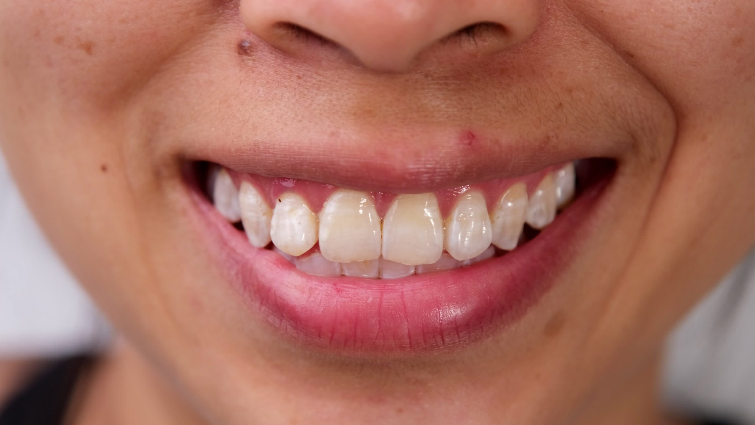 Karang Gigi: Punca, Pencegahan, dan Rawatan Sendiri atau Dentist?