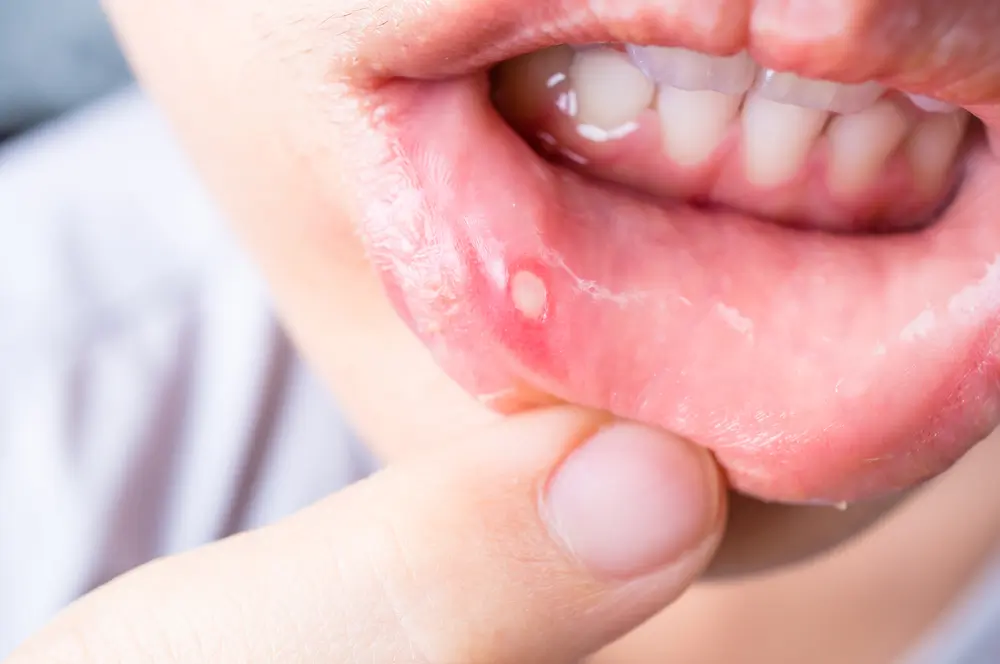 Takut Dengan Ulser Mulut? Tanda dan Rawatan Bagi Pemakai Braces